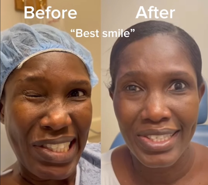 Facial nerve stroke before/after